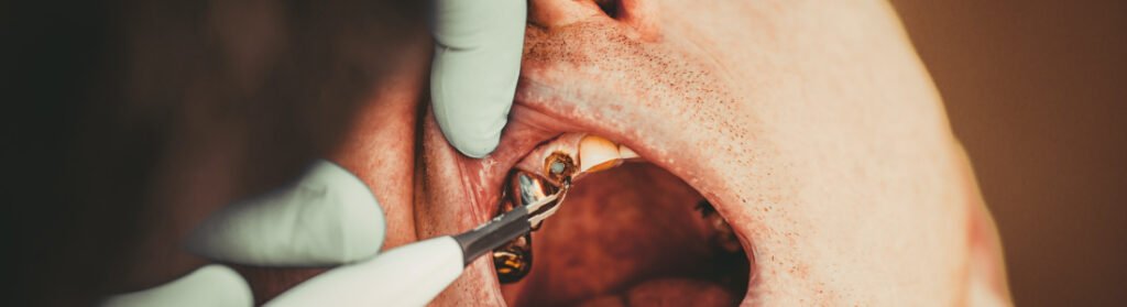 tooth fillings