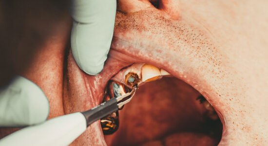 tooth fillings
