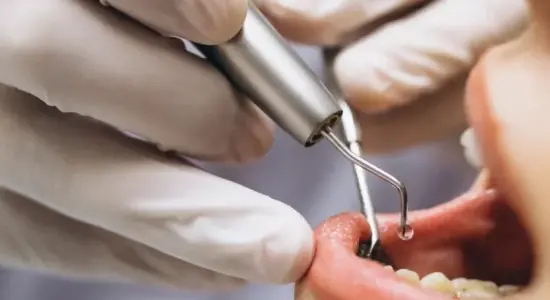 Root Canal