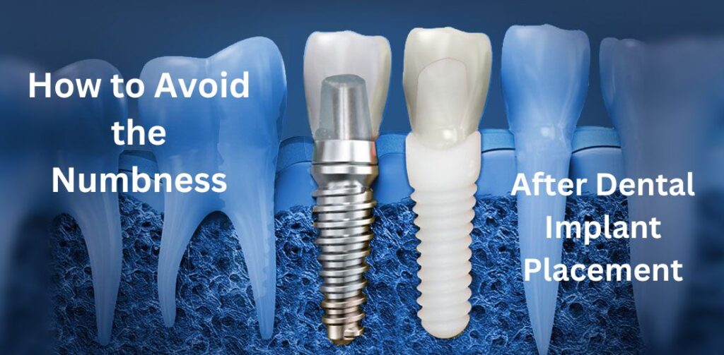 Avoid-numbness-after-dental-implants