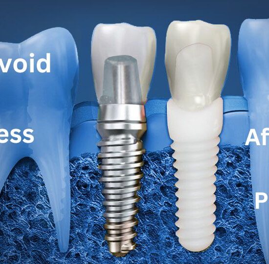 Avoid-numbness-after-dental-implants