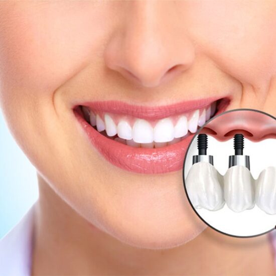 Make Your Dental Implants Look Amazing