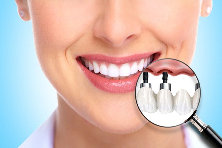 Make Your Dental Implants Look Amazing