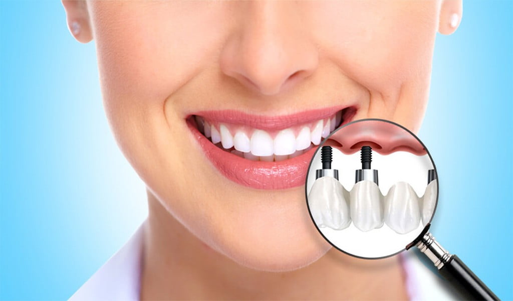 Make Your Dental Implants Look Amazing
