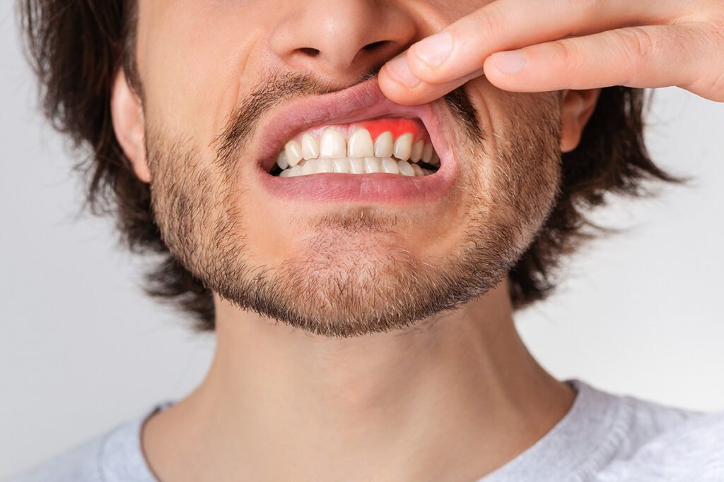 How to Know if You're Suffering from Gum Disease