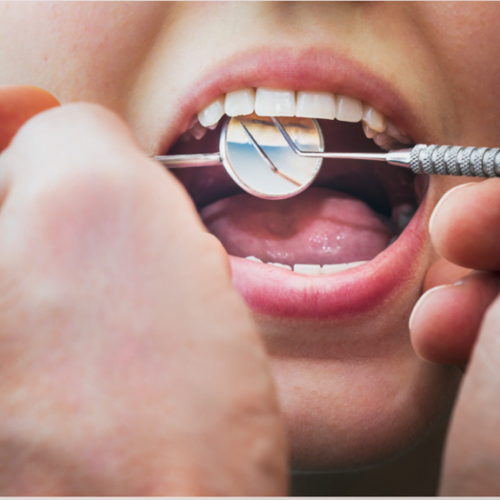 How to Remove Tetracycline Stains from Teeth