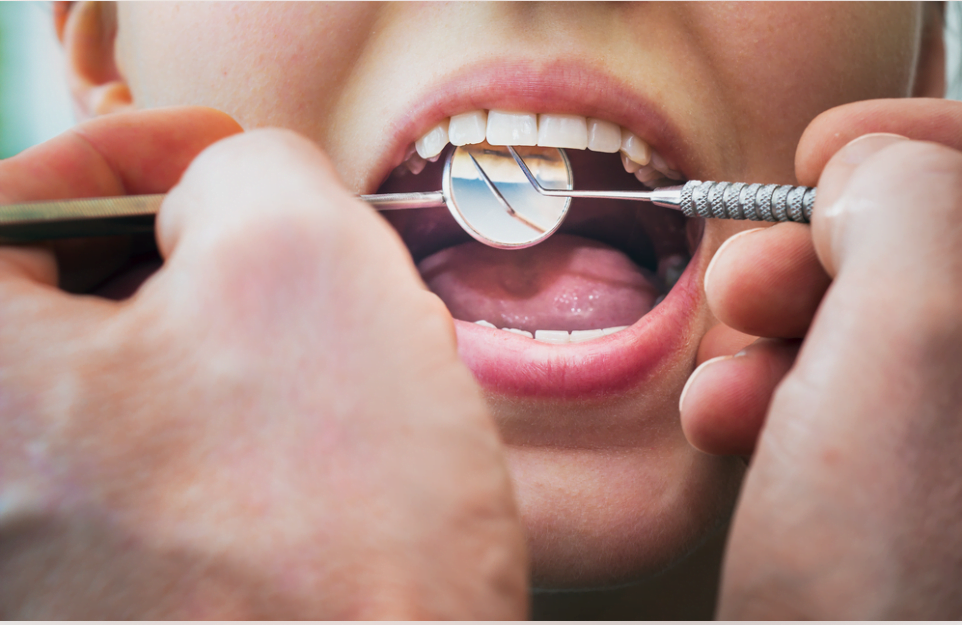 How to Remove Tetracycline Stains from Teeth