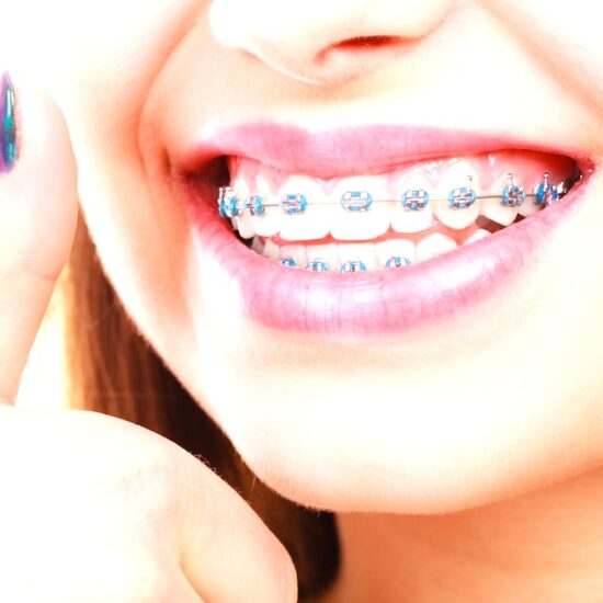 Braces Color
