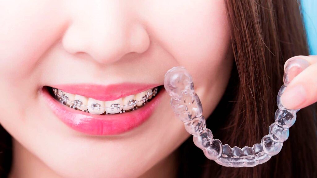 Invisalign vs. Braces