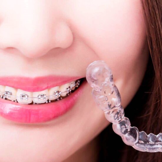 Invisalign vs. Braces