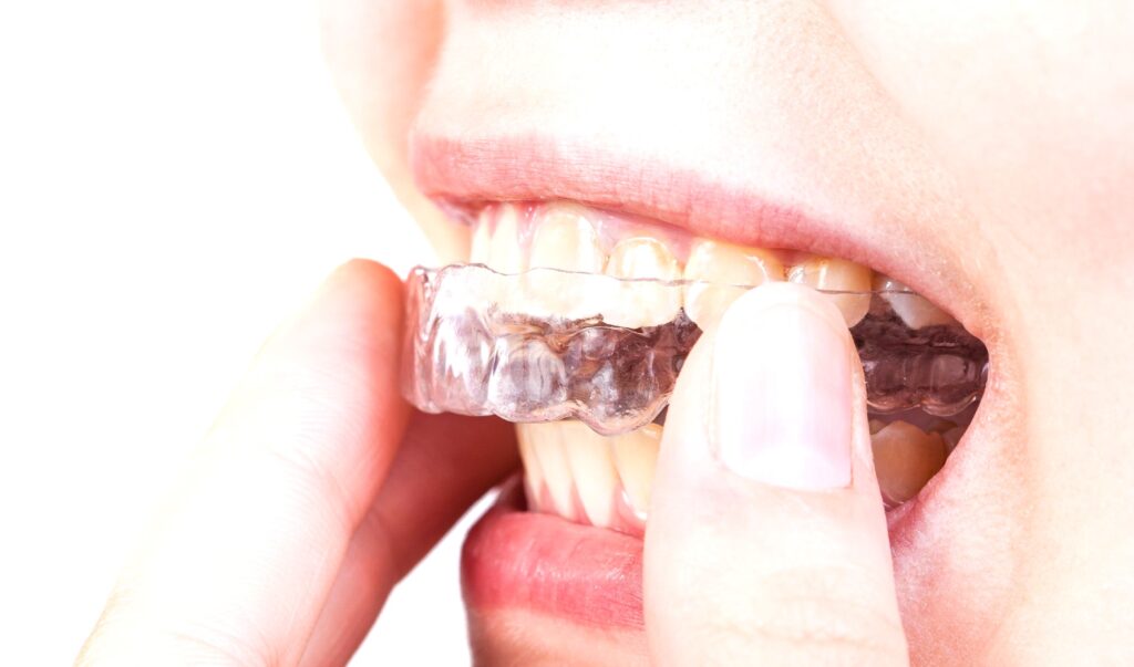 types of mouth guards