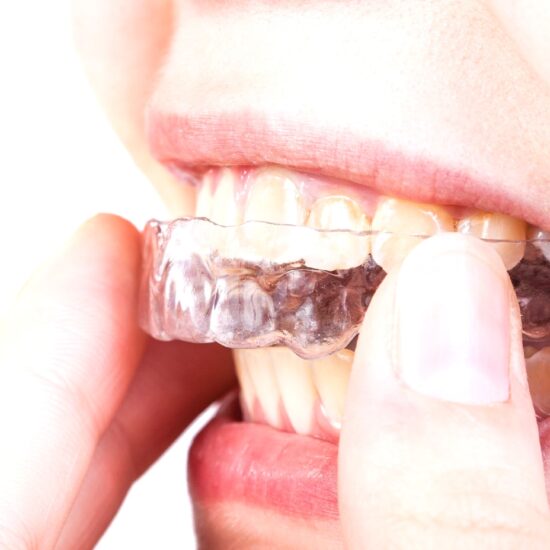 types of mouth guards