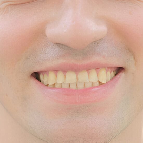 Discoloration of Teeth