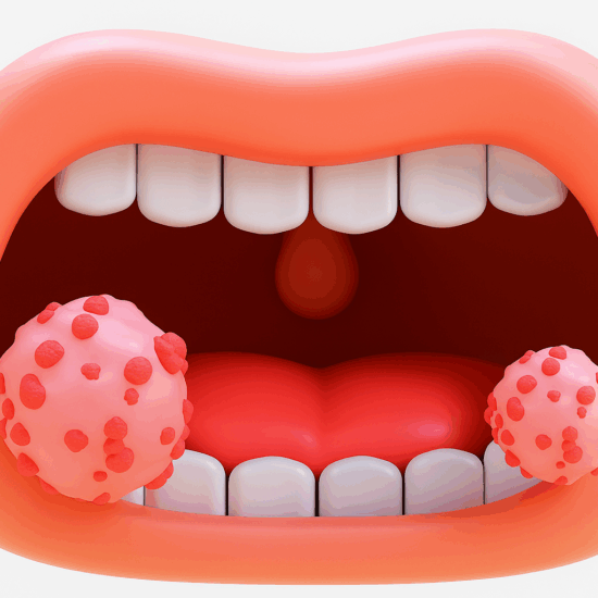 Mouth Cancer