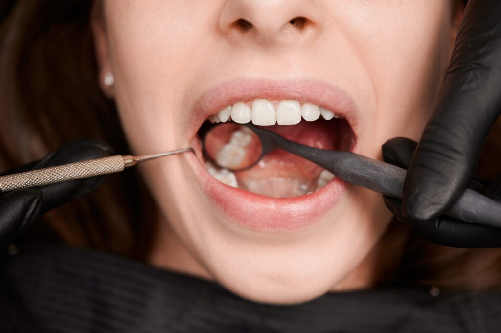 Enameloplasty