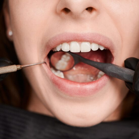 Enameloplasty